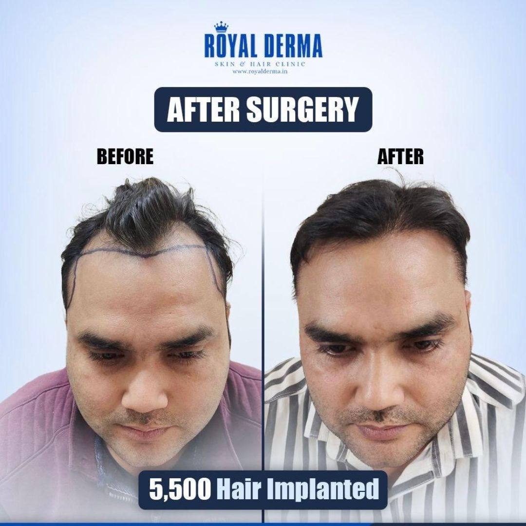 Hair regrowth after transplant