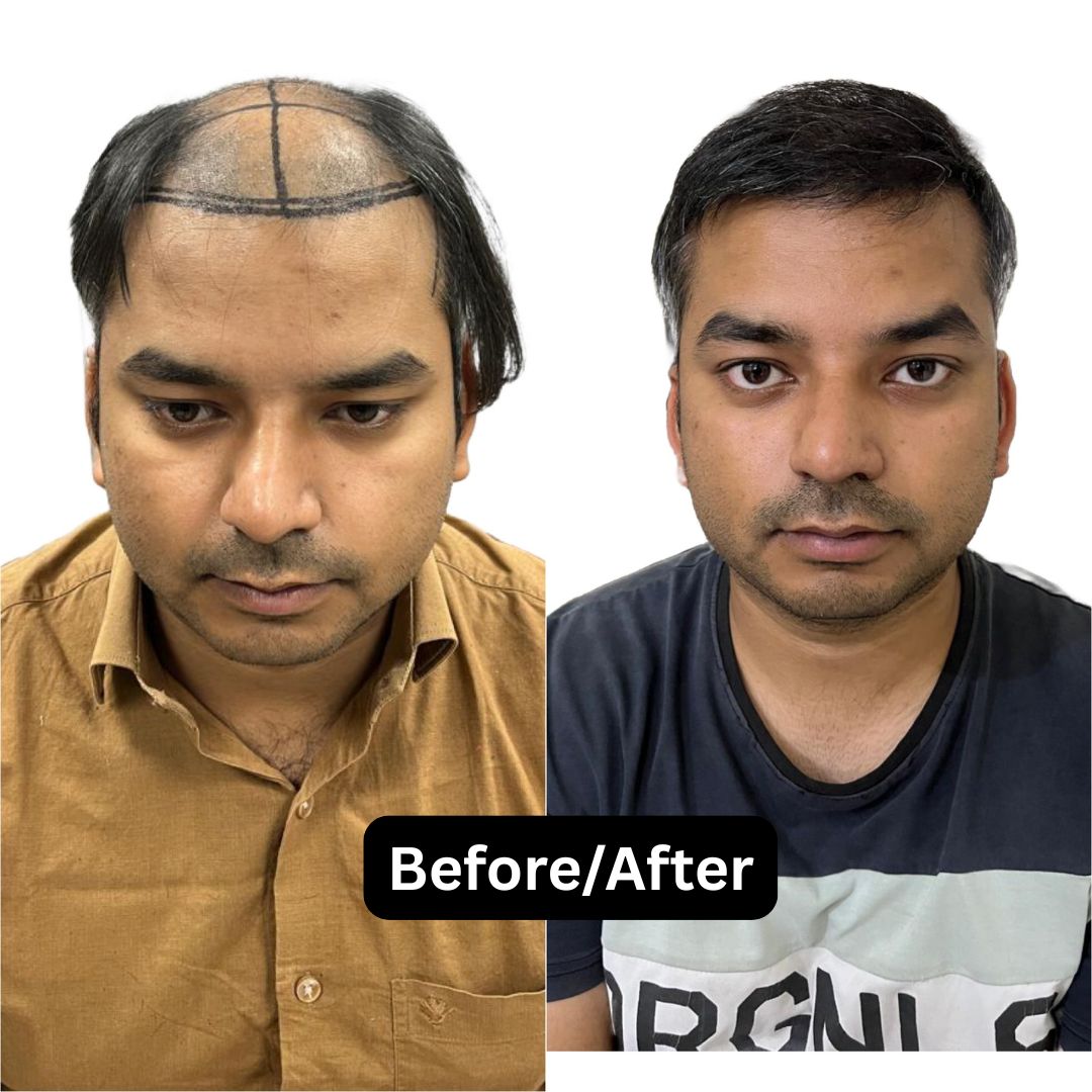 Hair restoration before after comparison Delhi