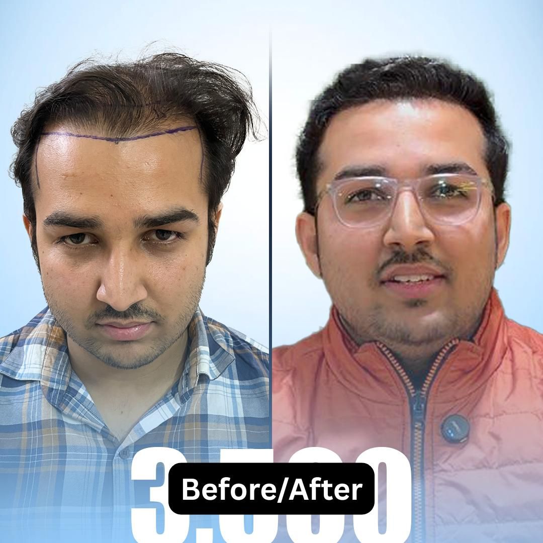 Hair transplant result Dwarka Delhi clinic