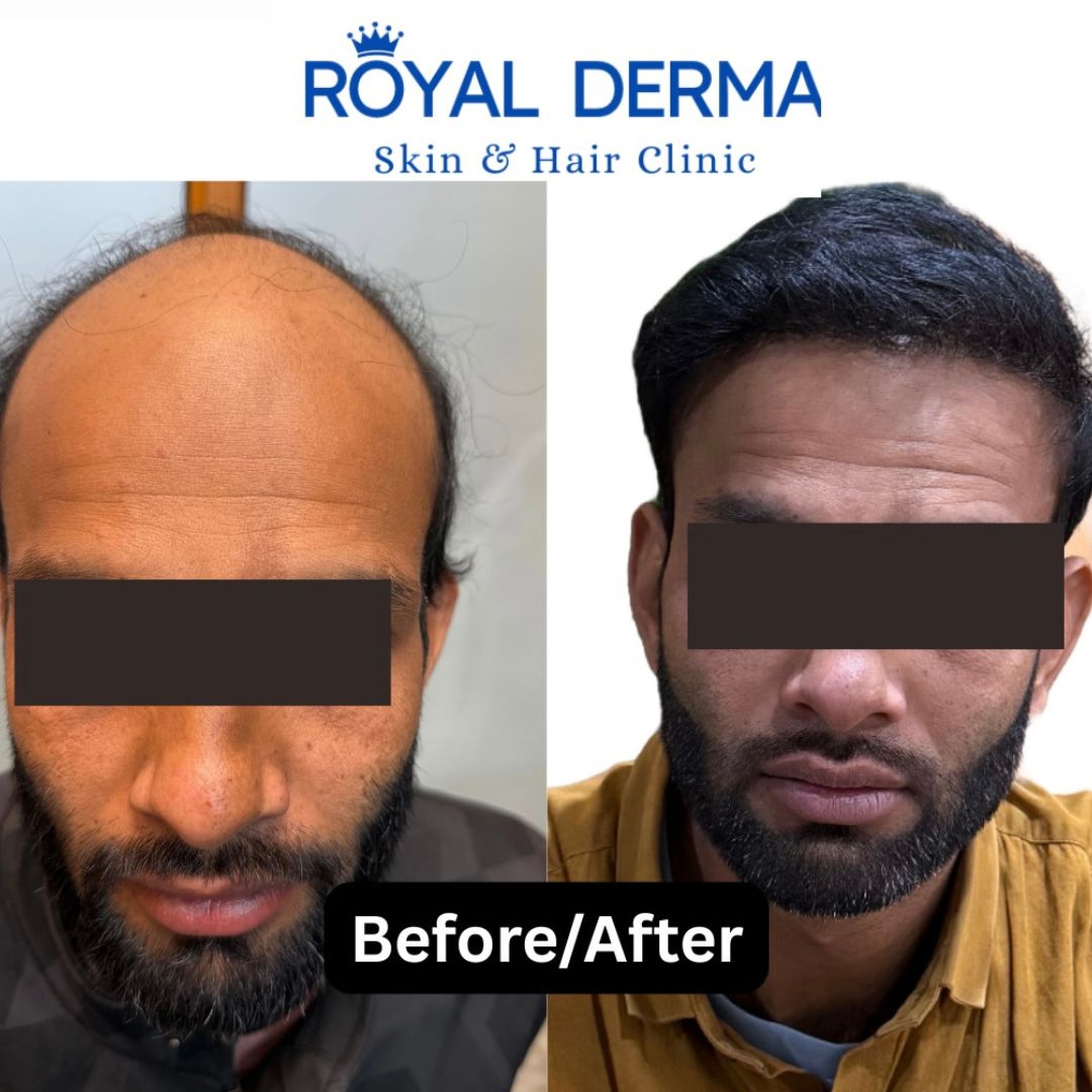 Male pattern baldness treatment result Delhi