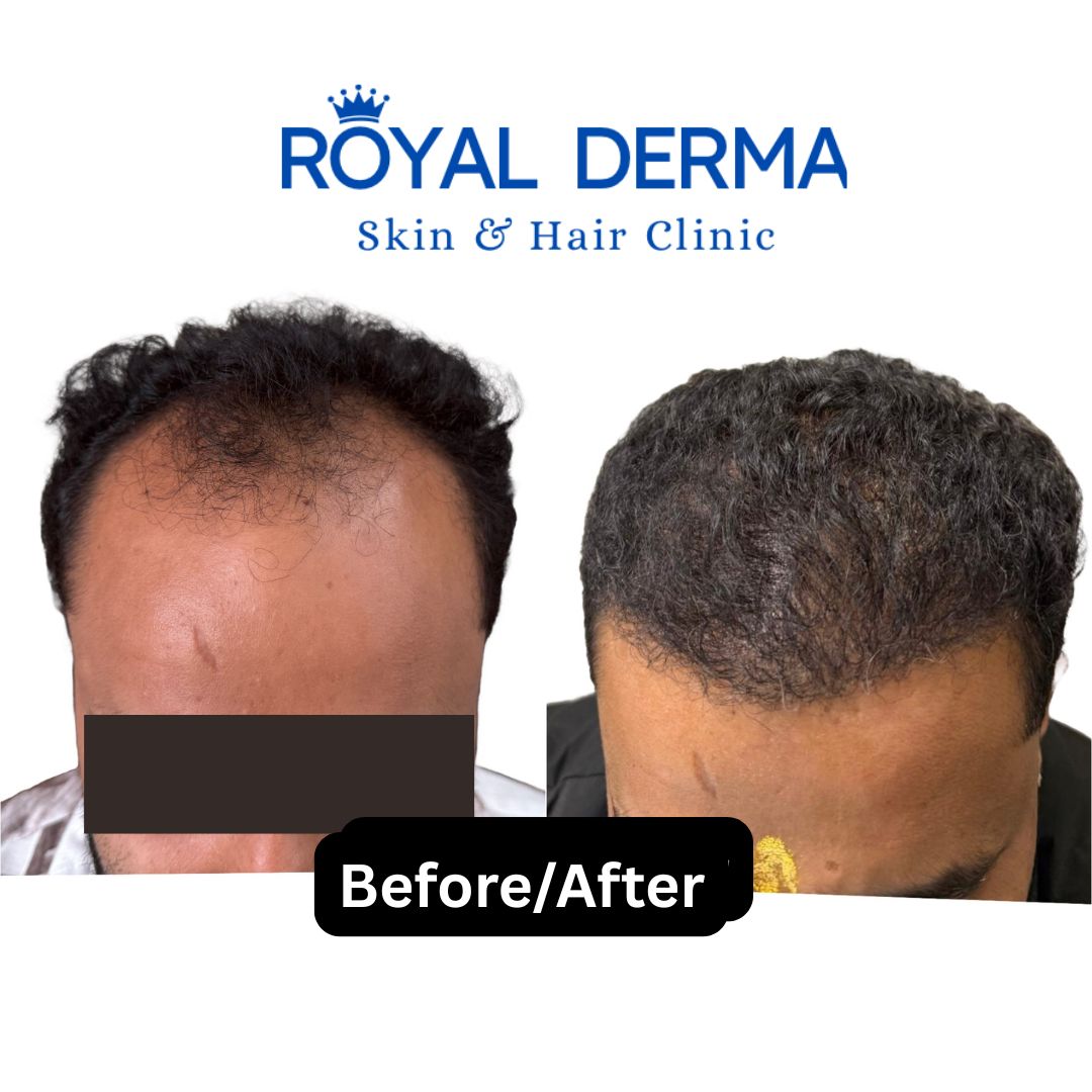 Minimally invasive FUE hair transplant result