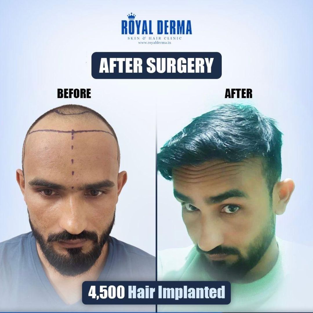 Natural looking hair transplant result Delhi