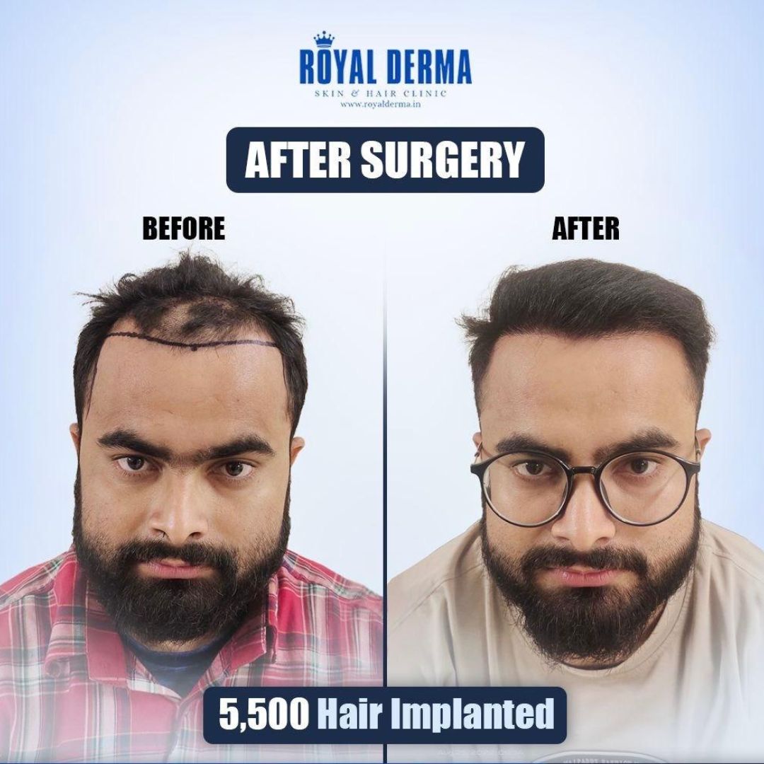 Visible hair regrowth after transplant Delhi