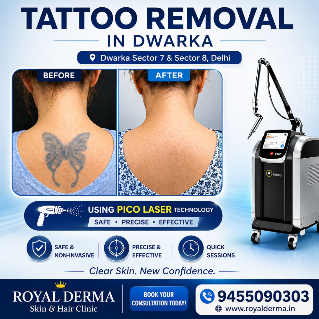 Tattoo Removal in Dwarka | Pico Laser Tattoo Removal Delhi | Royal Derma