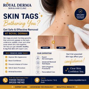 Safe Skin Tag Removal Treatment in Delhi Royal Derma