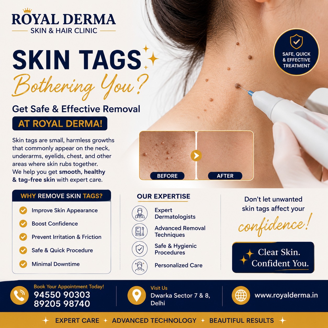 Safe Skin Tag Removal Treatment in Delhi Royal Derma