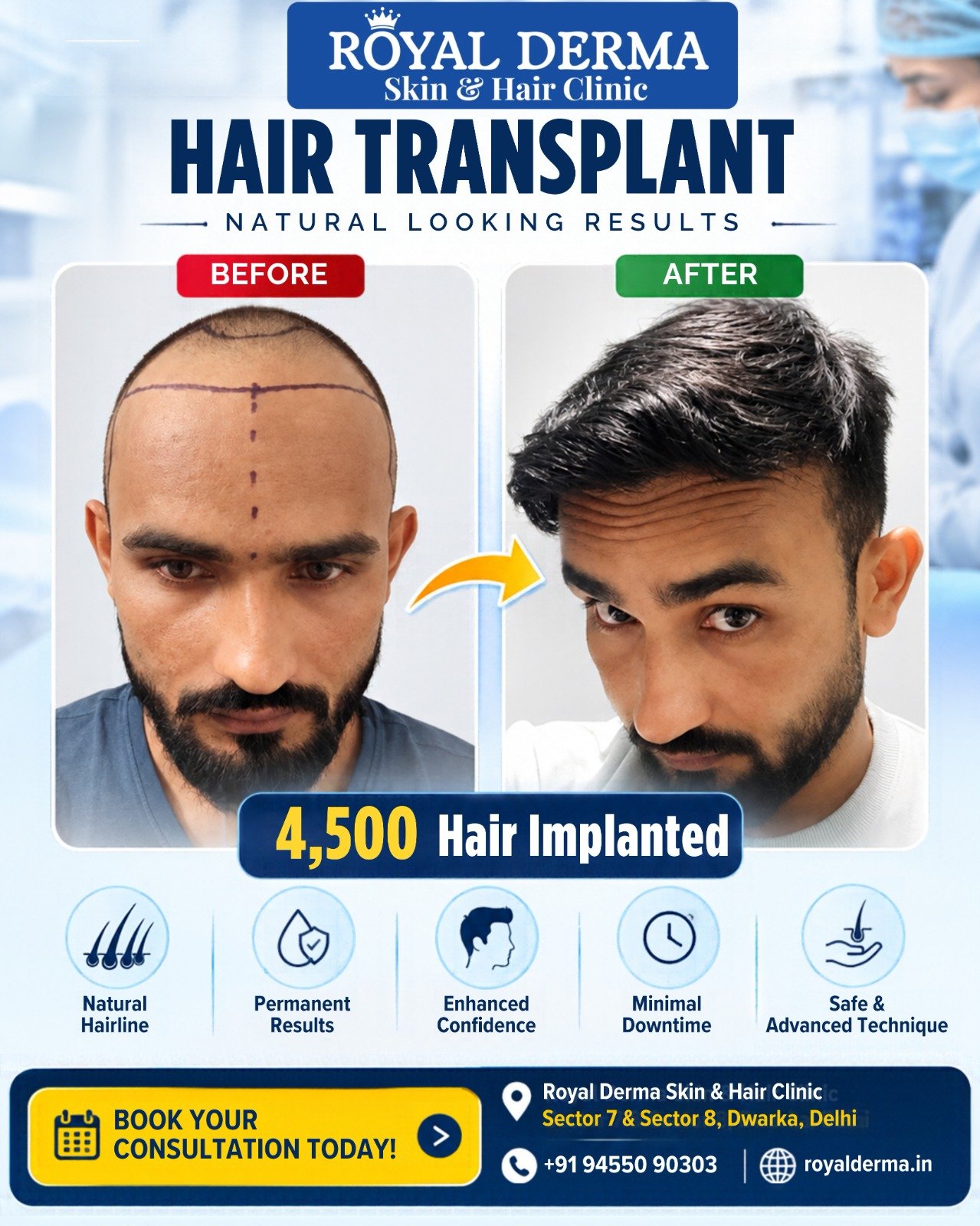 Hair Transplant in Dwarka, Delhi Royal Derma Clinic